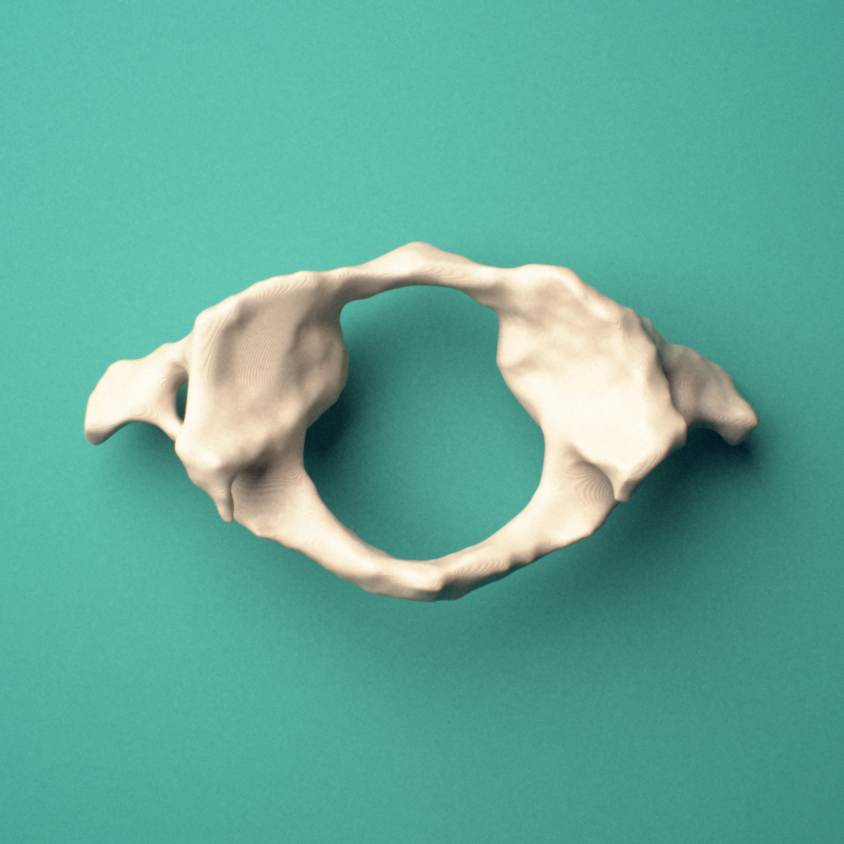 3D-printed C1 atlas vertebra, shown from a superior (top-down) view