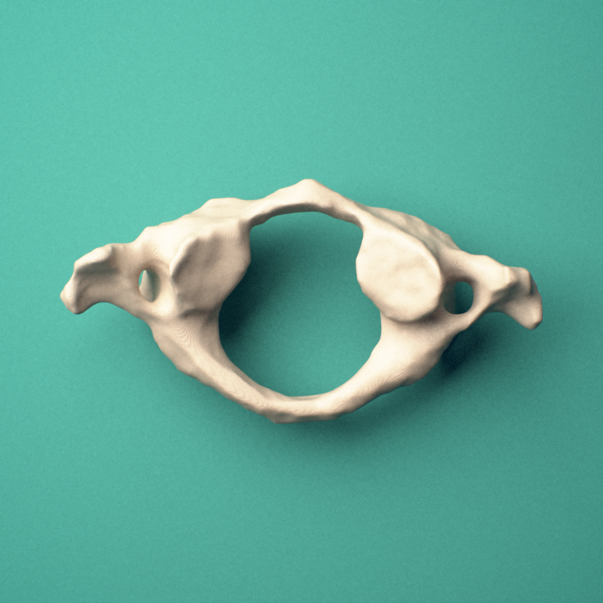 3D-printed C1 atlas vertebra, superior oblique view showing the superior articular facets.