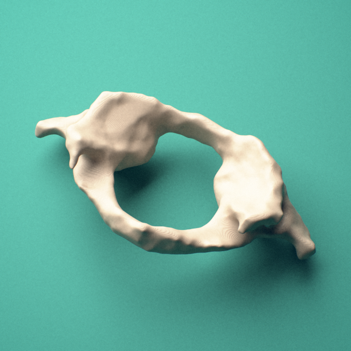3D-printed C1 atlas vertebra, posterior oblique view showing the posterior arch.
