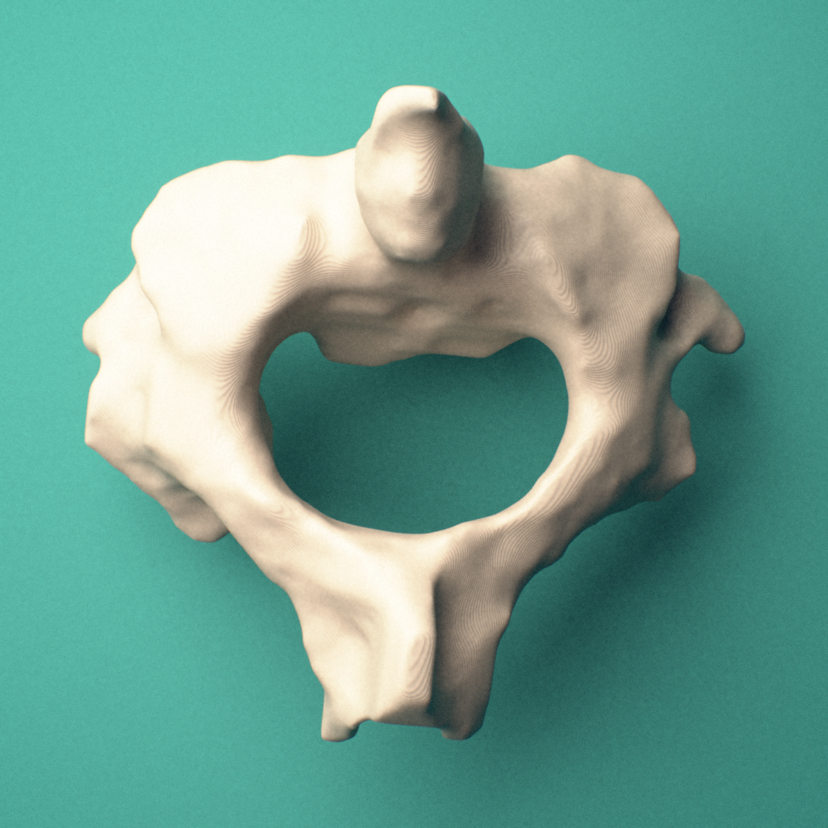 3D-printed C2 Axis cervical vertebra, anterior oblique view showing the dens (odontoid process) and vertebral body.