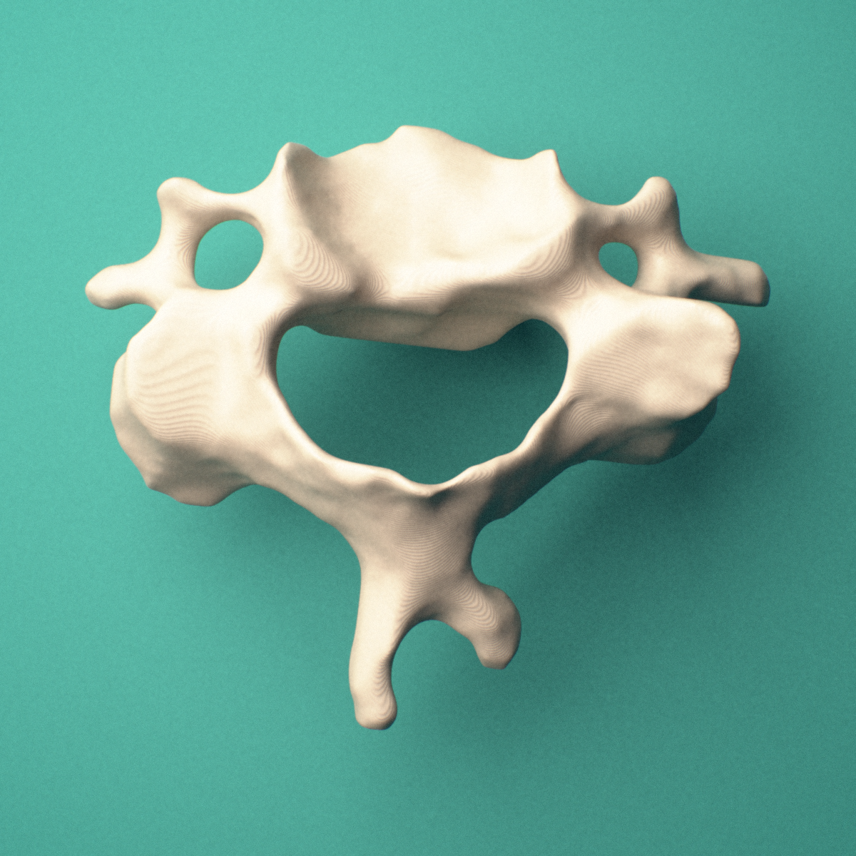 3D-printed C3 cervical vertebra, superior view showing the vertebral body, pedicles, and bifid spinous process.