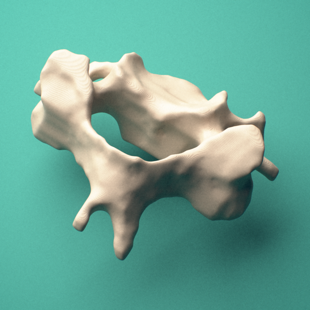 3D-printed C4 cervical vertebra, posterior oblique view showing the laminae and bifid spinous process.