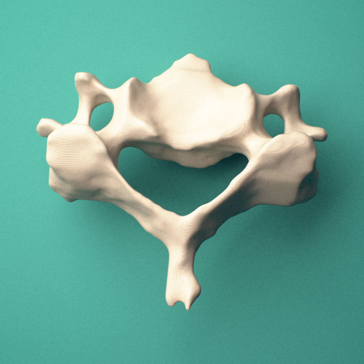 3D-printed C5 cervical vertebra, superior view showing the vertebral body, pedicles, and bifid spinous process.