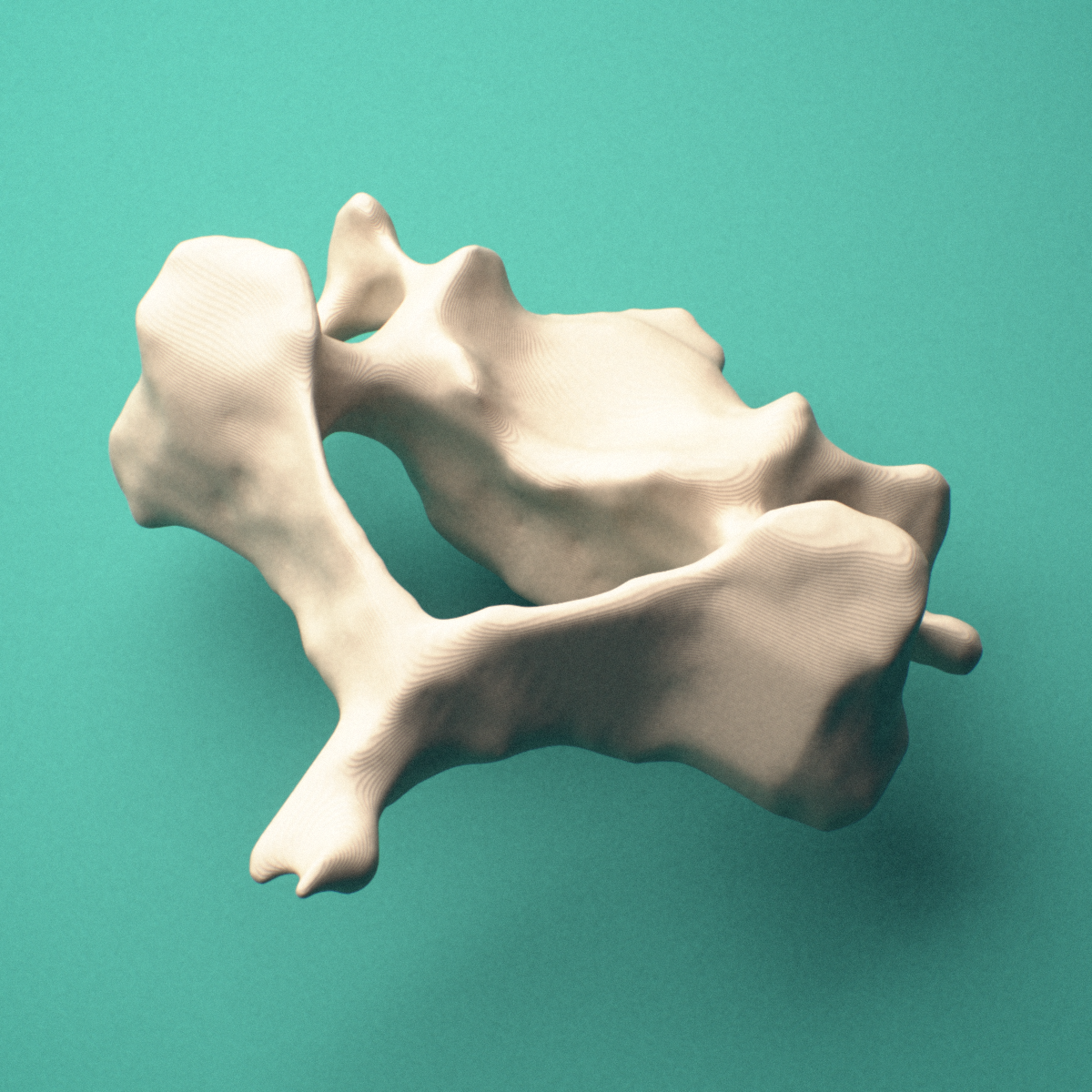 3D-printed C5 cervical vertebra, posterior oblique view showing the laminae and bifid spinous process.