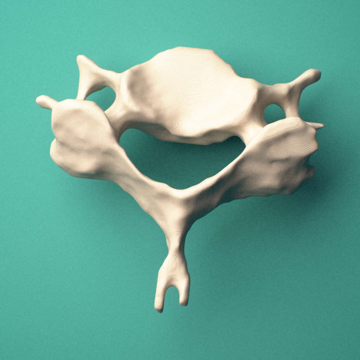 3D-printed C6 cervical vertebra, superior view showing the vertebral body, pedicles, and bifid spinous process.
