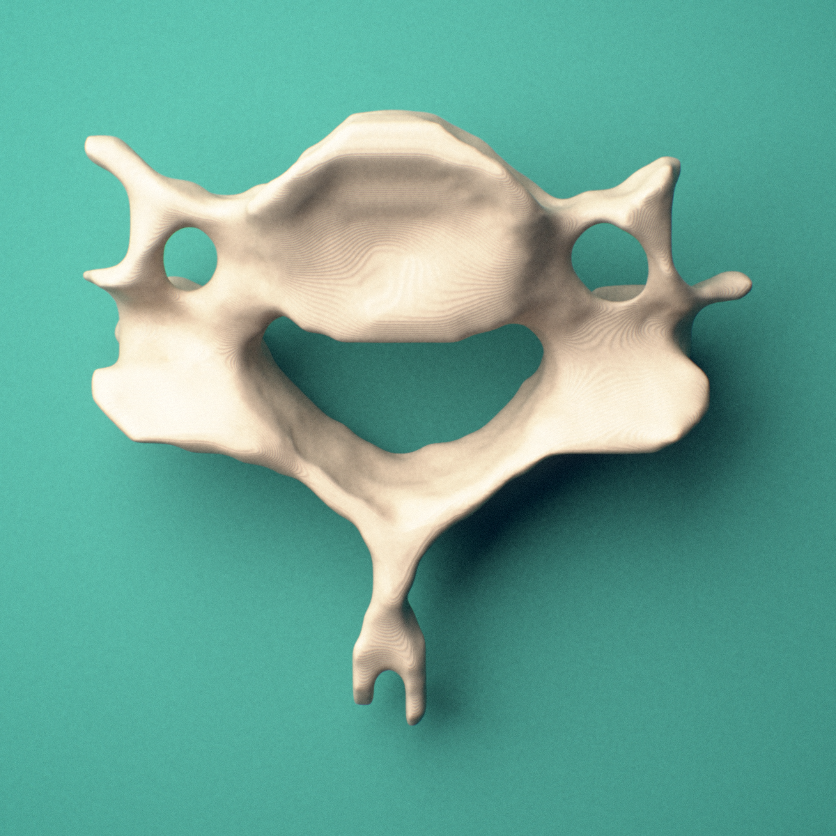 3D-printed C6 cervical vertebra, superior oblique view showing the bifid spinous process and superior articular facets.