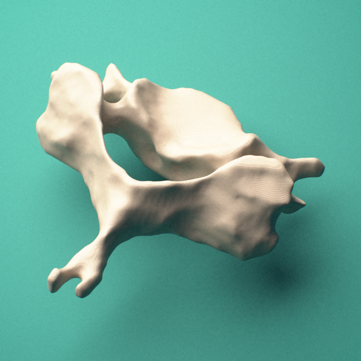 3D-printed C6 cervical vertebra, posterior oblique view showing the laminae and bifid spinous process.