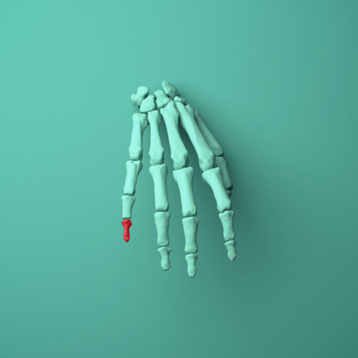 3D model of the Right little finger distal phalanx shown in position within a full hand and wrist model, anterior view.