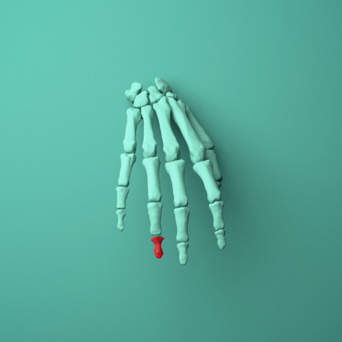 3D model of the Right ring finger distal phalanx shown in position within a full hand and wrist model, anterior view.