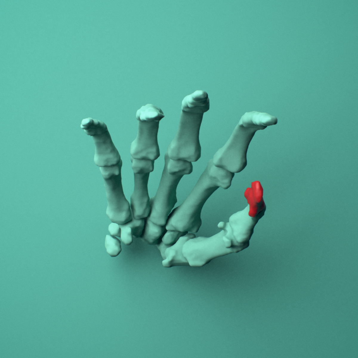 3D model of the Right thumb distal phalanx shown in position within a full hand and wrist model, inferior view.