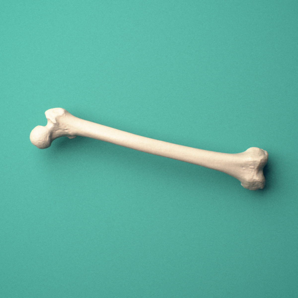 3D-printed Left femur (thigh bone), oblique view showing the femoral head and greater trochanter and medial and lateral condyles.