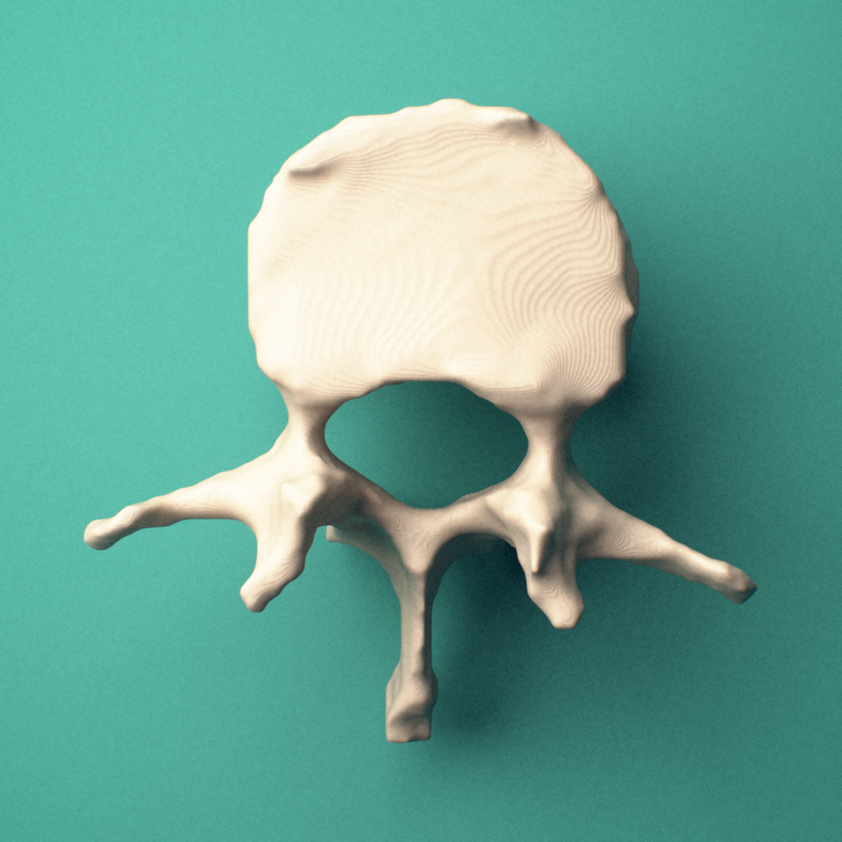 3D-printed L1 lumbar vertebra, superior view showing the vertebral body and vertebral foramen.