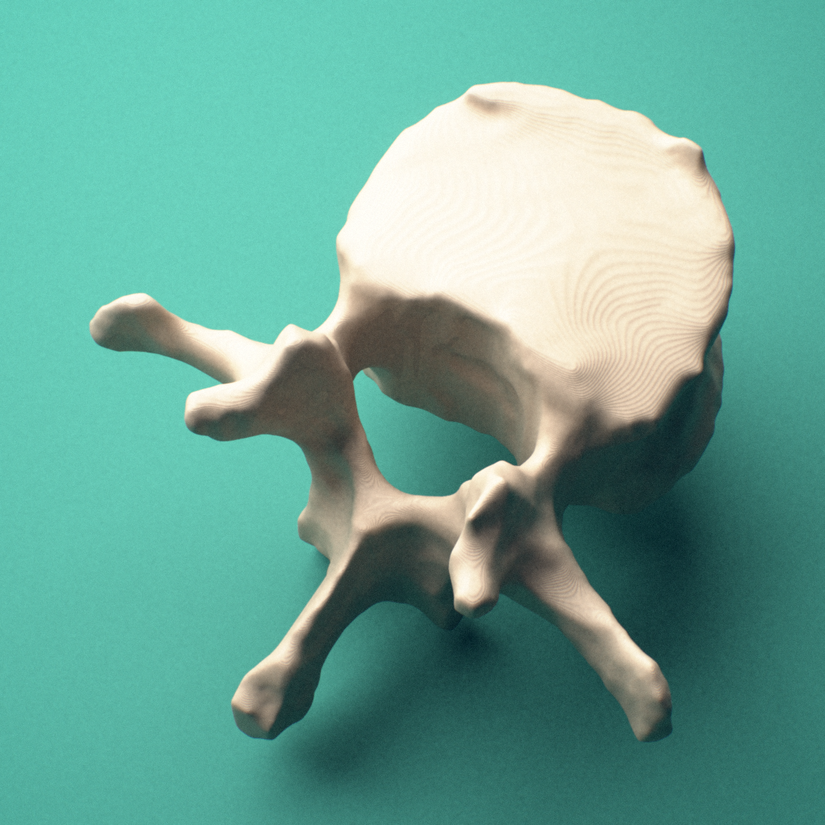 3D-printed L1 lumbar vertebra, posterior oblique view showing the laminae and spinous process.