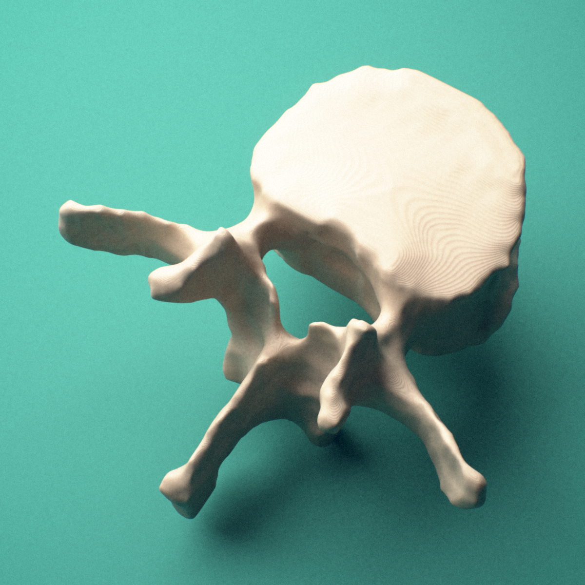 3D-printed L2 lumbar vertebra, posterior oblique view showing the laminae and spinous process.