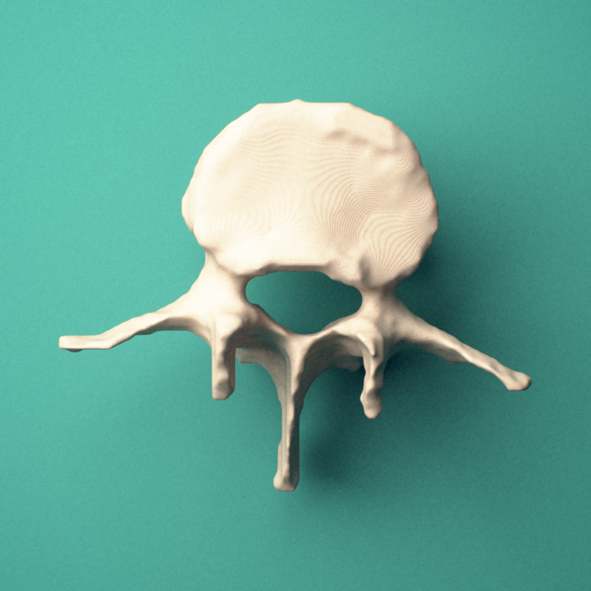 3D-printed L3 lumbar vertebra, superior view showing the vertebral body and vertebral foramen.