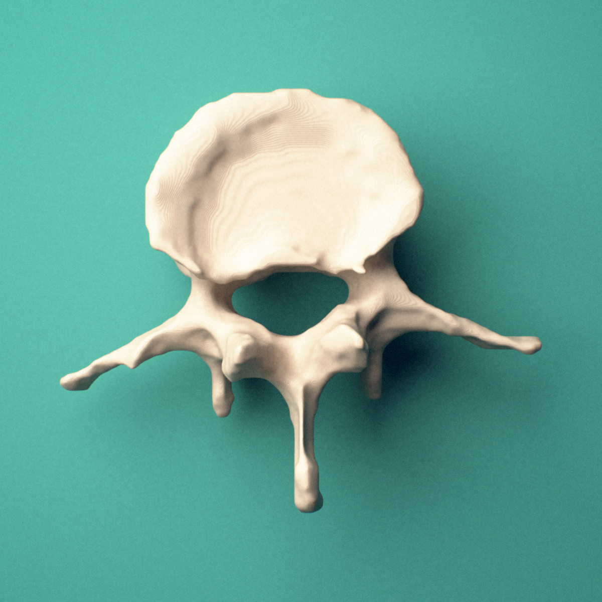 3D-printed L3 lumbar vertebra, posterior view showing the spinous process and transverse processes.