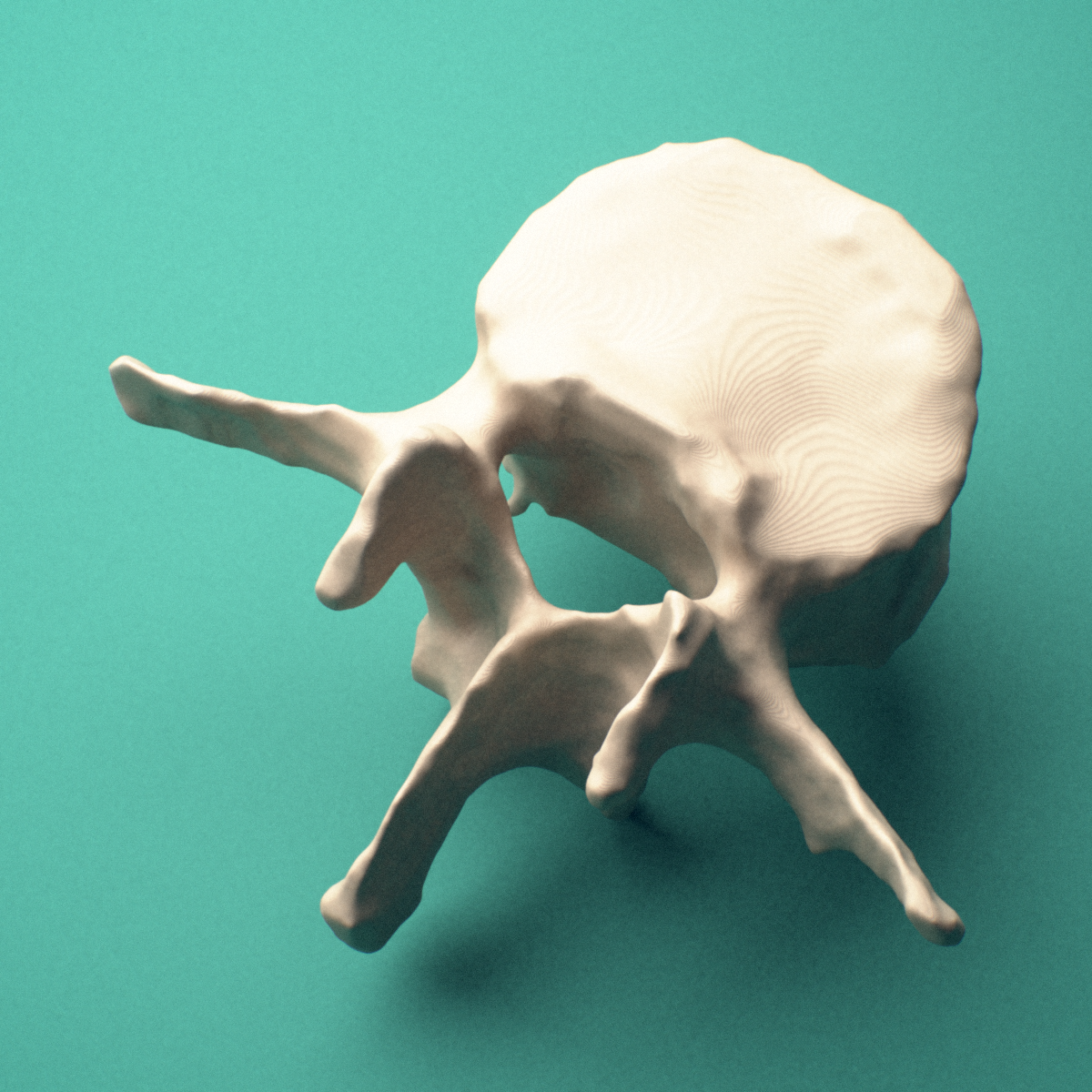3D-printed L3 lumbar vertebra, posterior oblique view showing the laminae and spinous process.