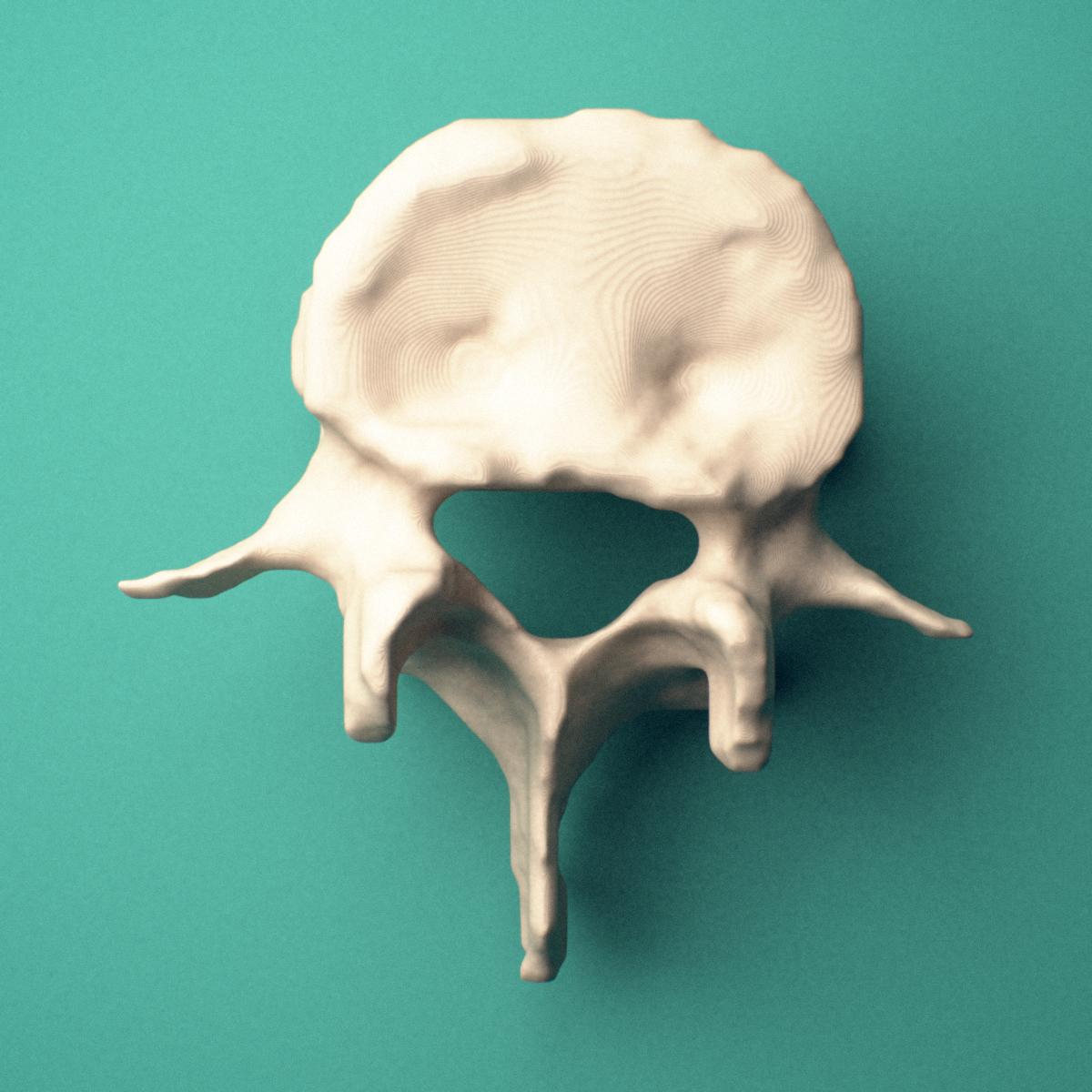 3D-printed L4 lumbar vertebra, superior view showing the vertebral body and vertebral foramen.