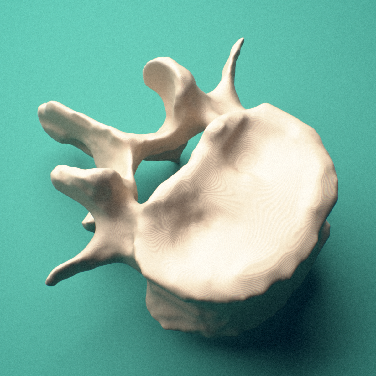 3D-printed L4 lumbar vertebra, posterior oblique view showing the laminae and spinous process.