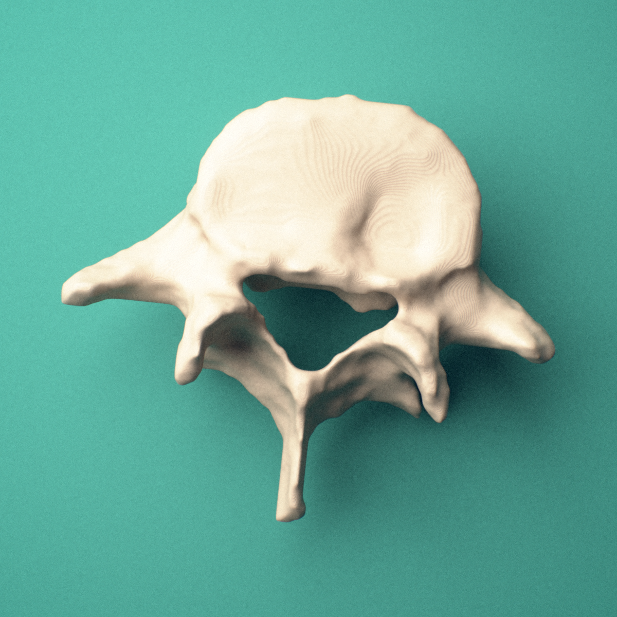 3D-printed L5 lumbar vertebra, superior view showing the vertebral body, pedicles, and spinous process.