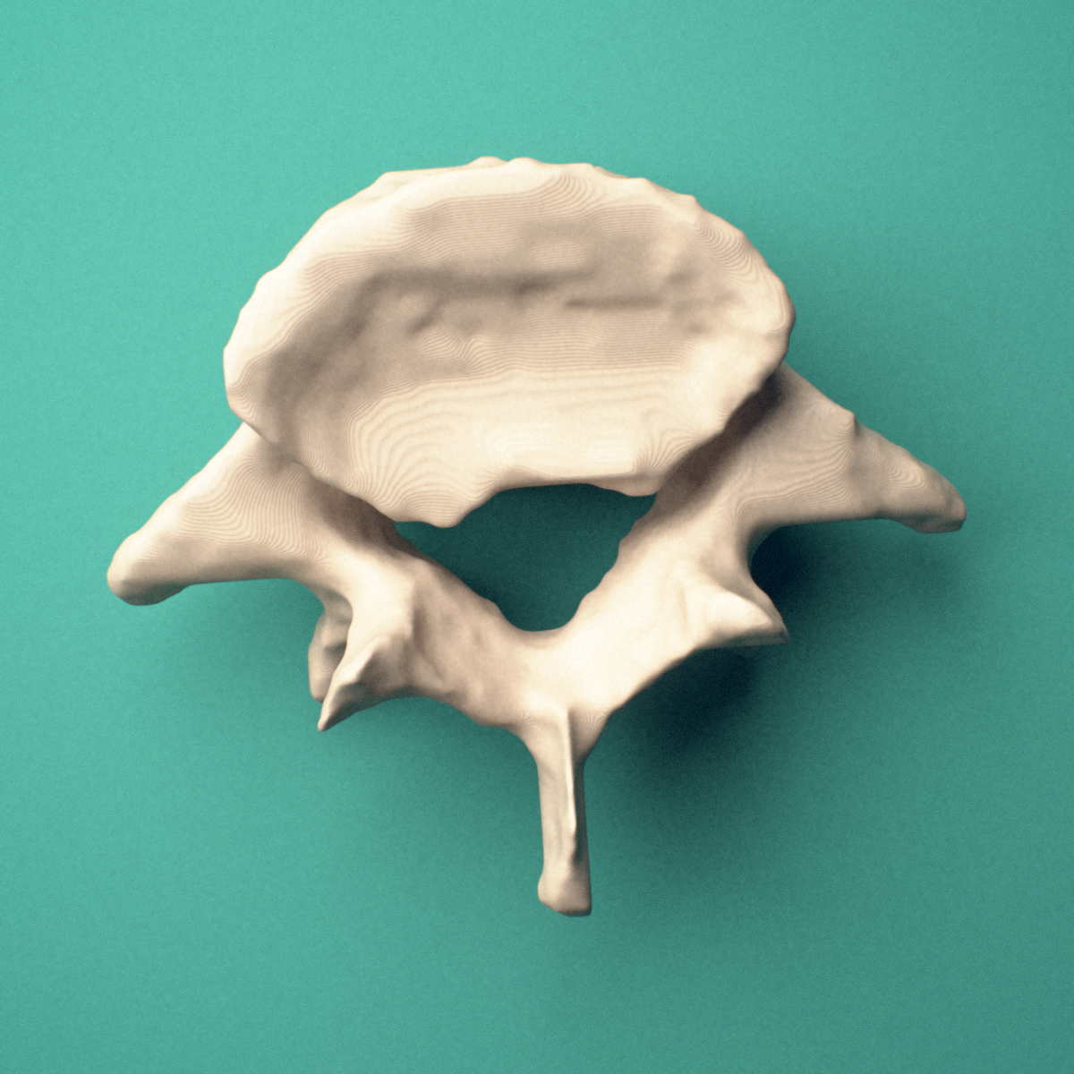 3D-printed L5 lumbar vertebra, superior oblique view showing the superior articular processes and vertebral foramen.