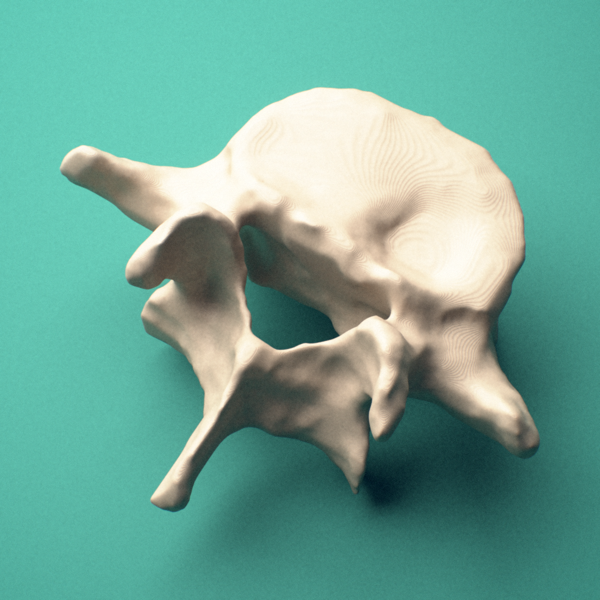 3D-printed L5 lumbar vertebra, posterior oblique view showing the laminae and spinous process.