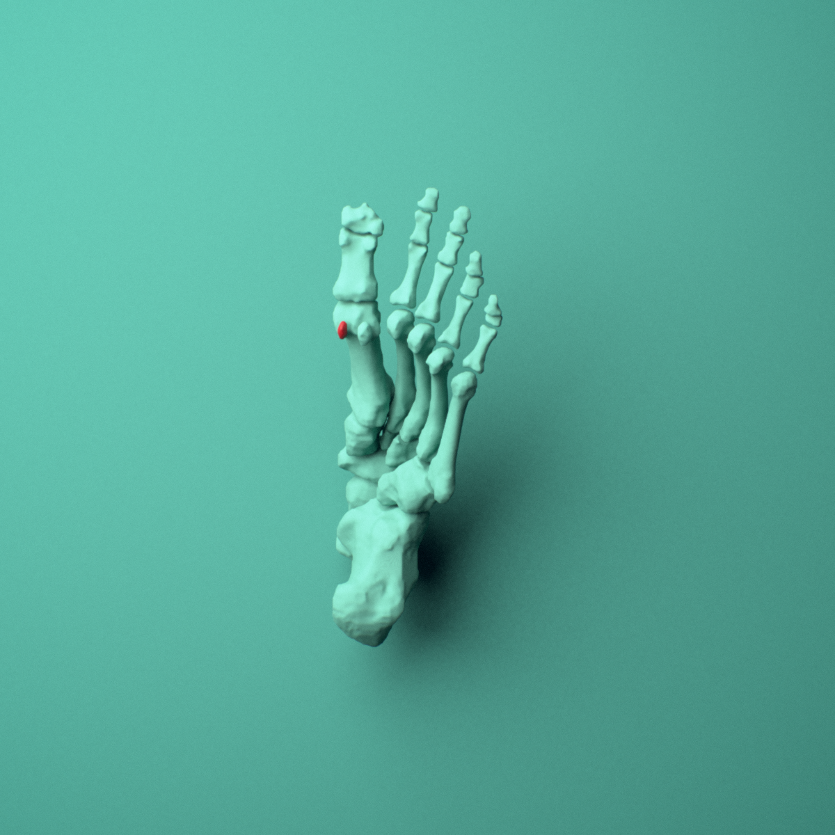 3D model of the Left lateral fibular sesamoid bone (foot) shown in position within a full foot and ankle model, inferior view.