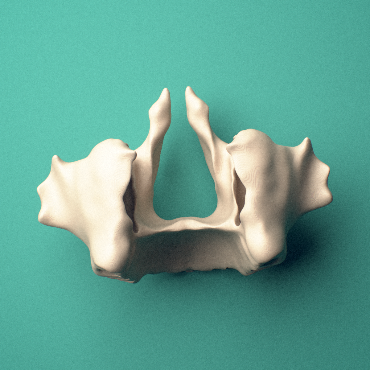 3D-printed Maxilla, fused, oblique view showing the infraorbital foramen.