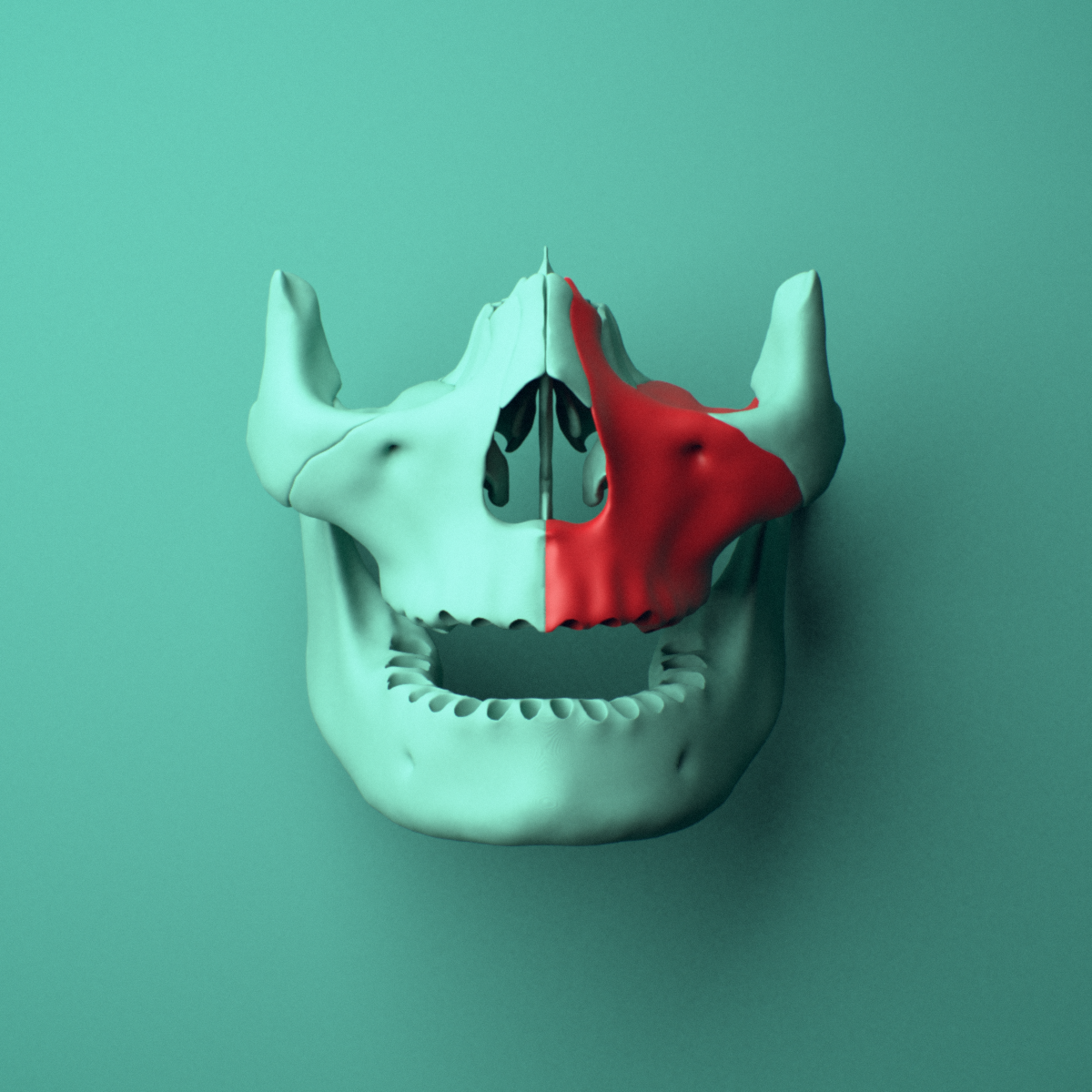 3D model of the Left maxilla shown in position within a full skull model, anterior view.