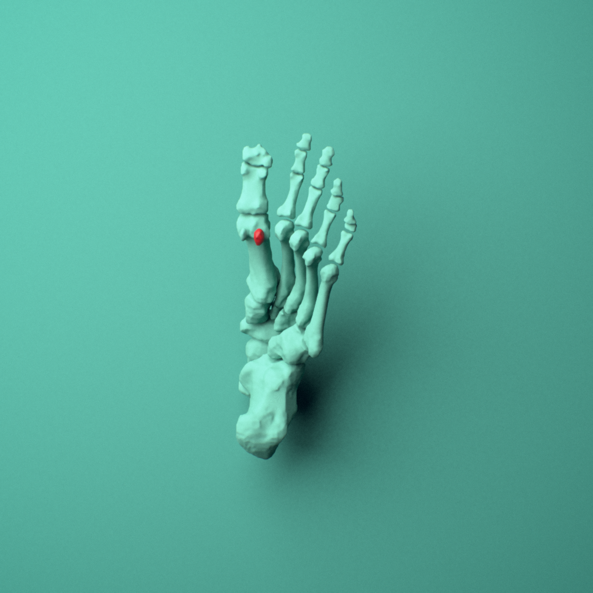 3D model of the Left medial tibial sesamoid bone (foot) shown in position within a full foot and ankle model, inferior view.