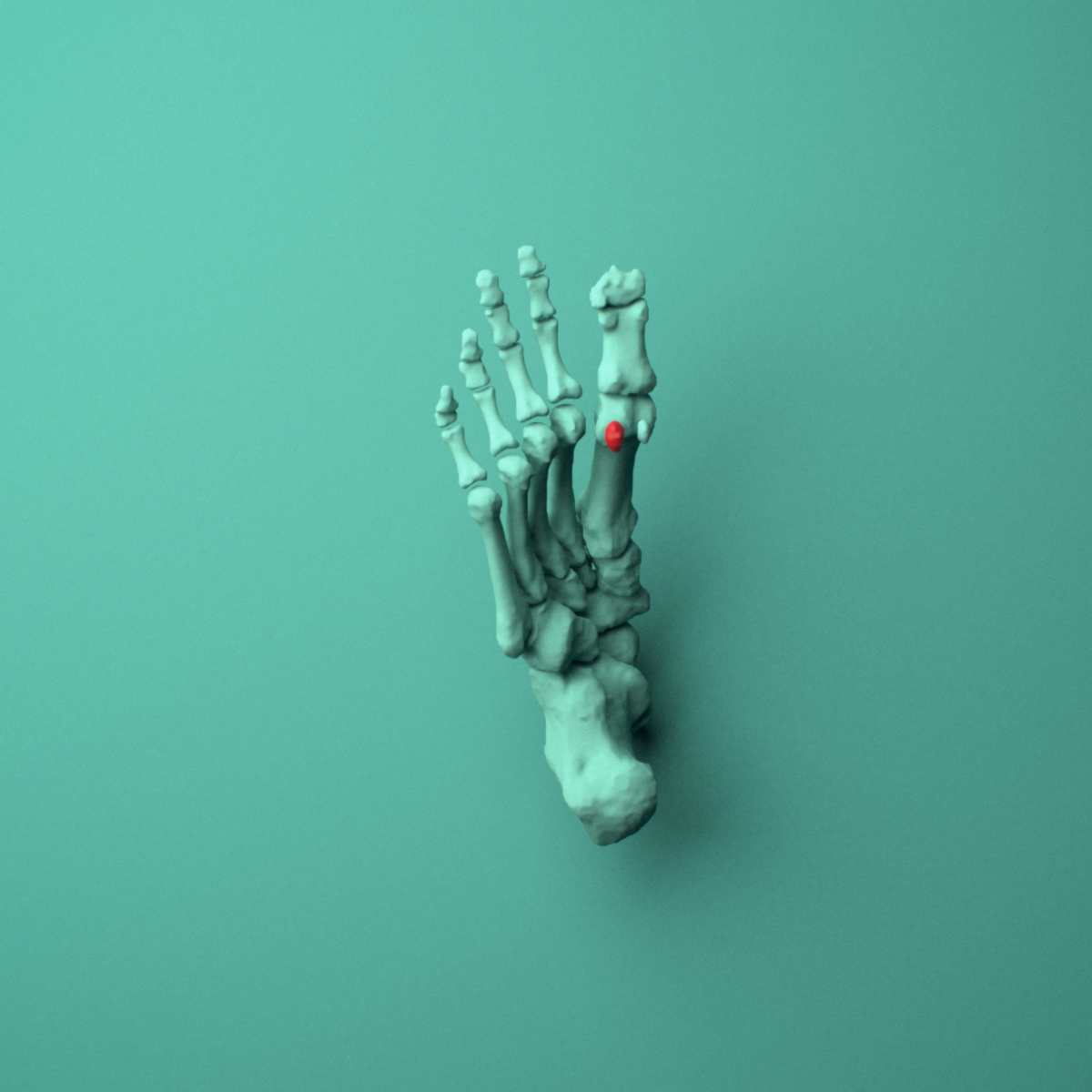 3D model of the Right medial tibial sesamoid bone (foot) shown in position within a full foot and ankle model, inferior view.