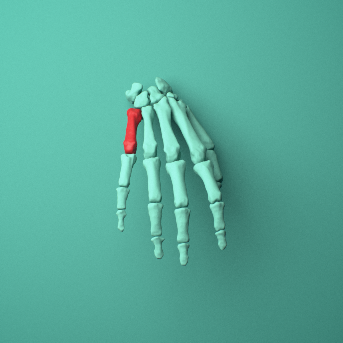 3D model of the Right fifth metacarpal (hand) shown in position within a full hand and wrist model, anterior view.