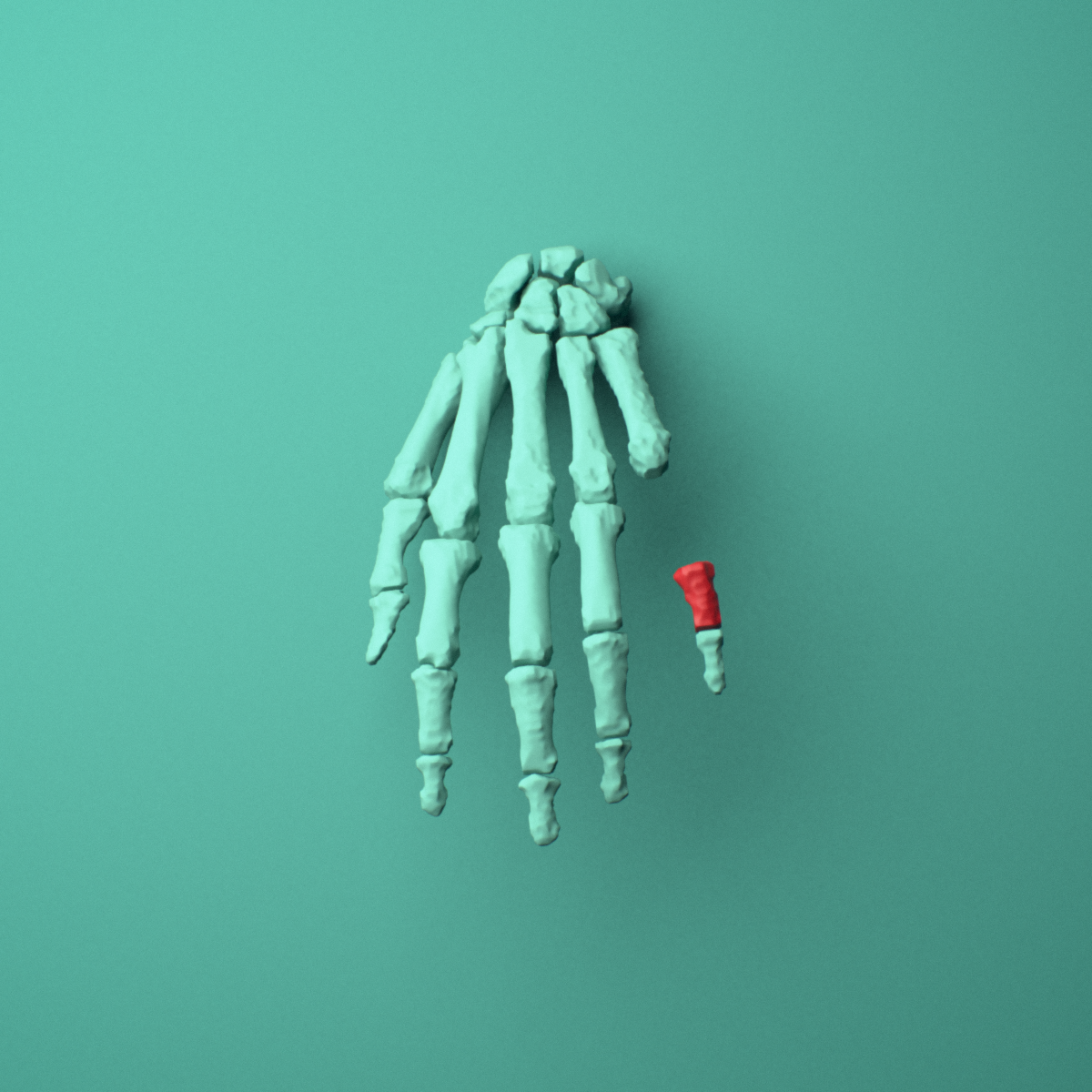 3D model of the Left little finger middle phalanx shown in position within a full hand and wrist model, anterior view.