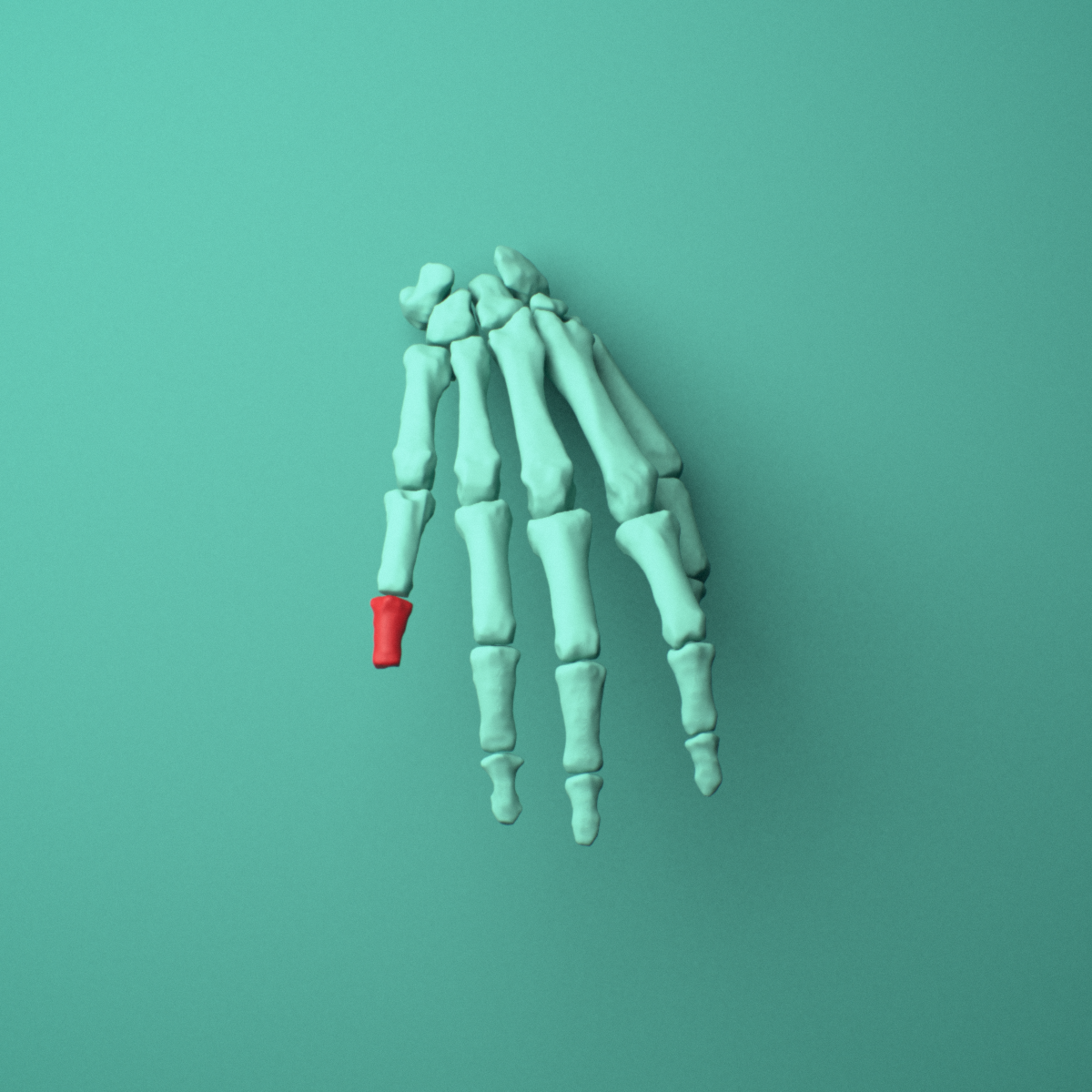 3D model of the Right little finger middle phalanx shown in position within a full hand and wrist model, anterior view.