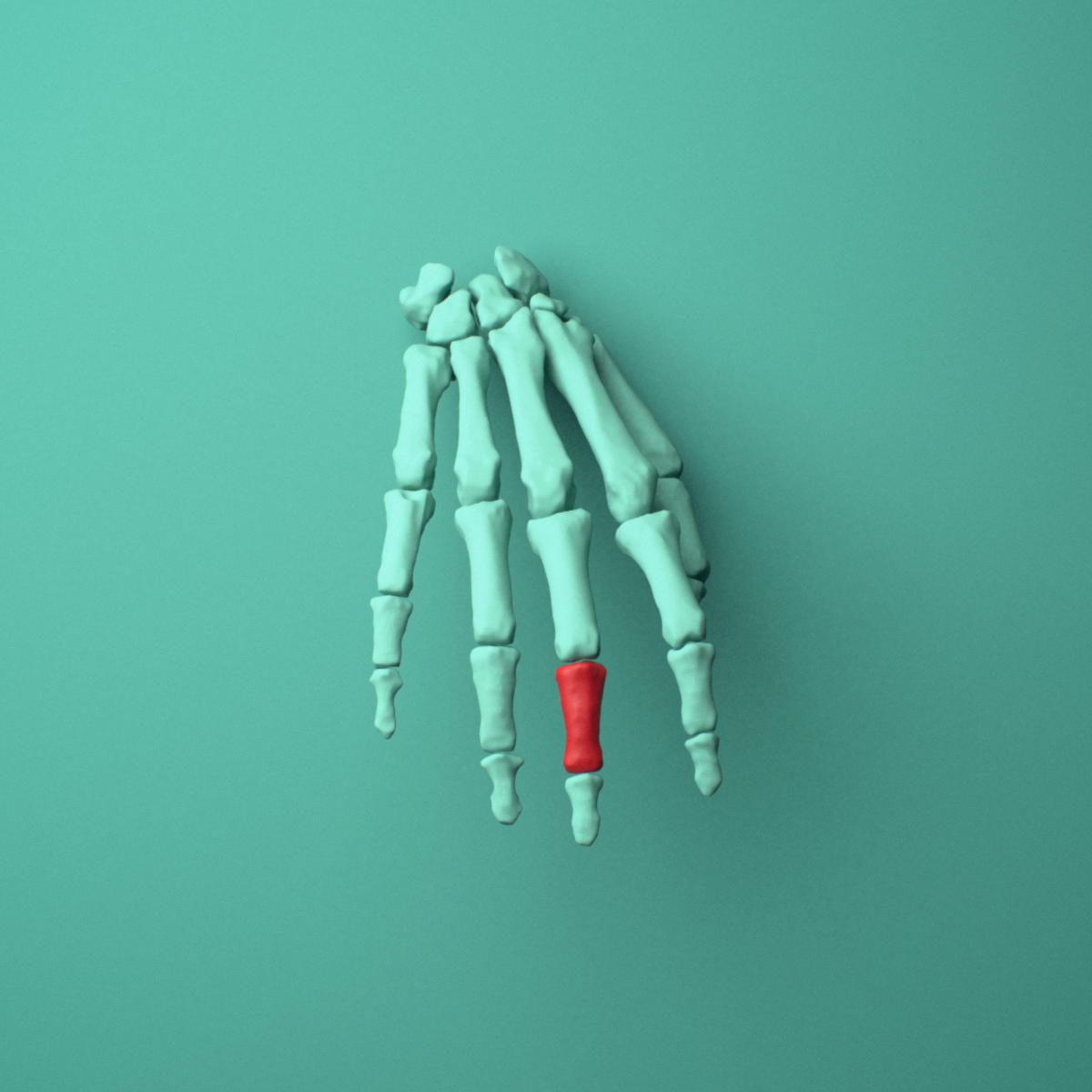 3D model of the Right middle finger middle phalanx shown in position within a full hand and wrist model, anterior view.