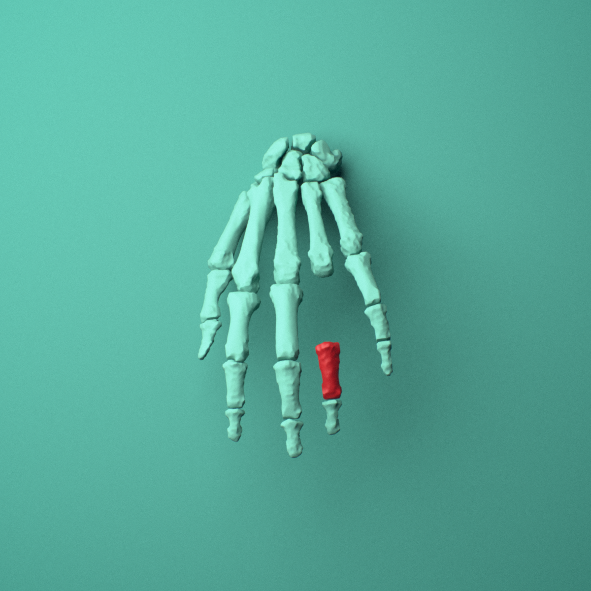 3D model of the Left ring finger middle phalanx shown in position within a full hand and wrist model, anterior view.