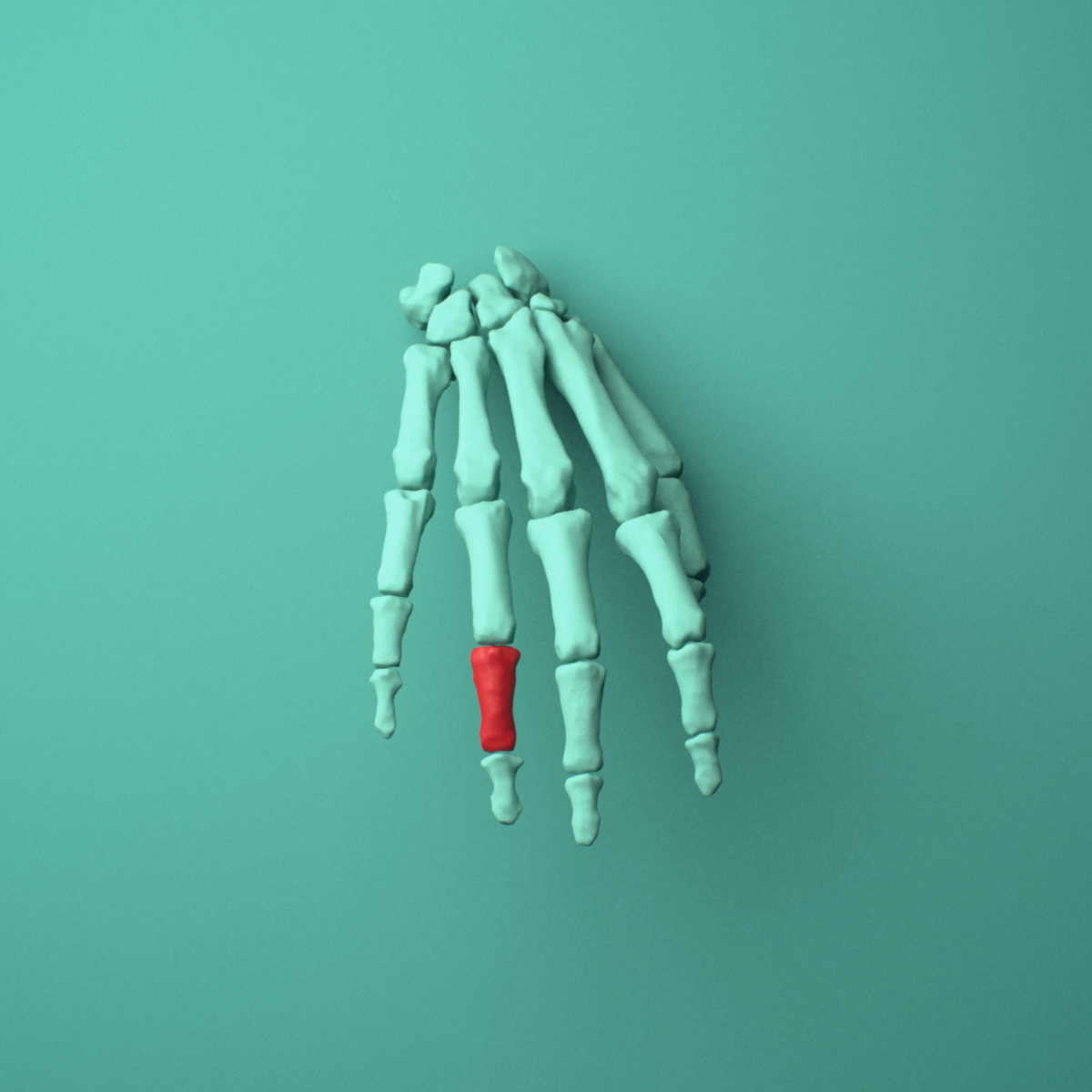 3D model of the Right ring finger middle phalanx shown in position within a full hand and wrist model, anterior view.