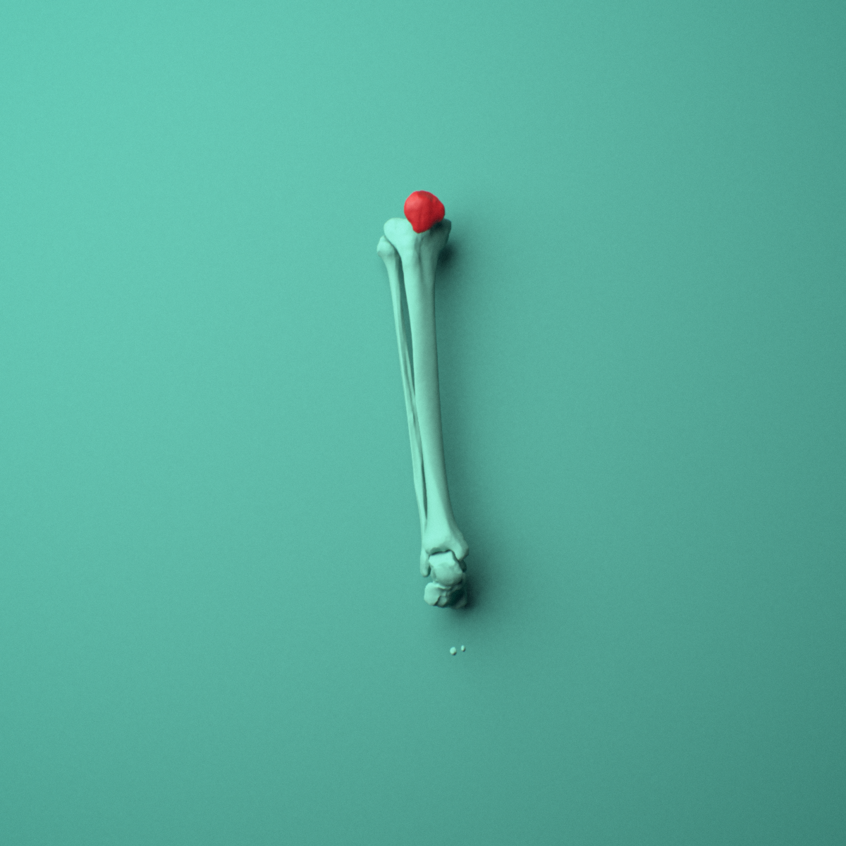 3D model of the Right patella (kneecap) shown in position within a full knee and lower leg model, anterior view.