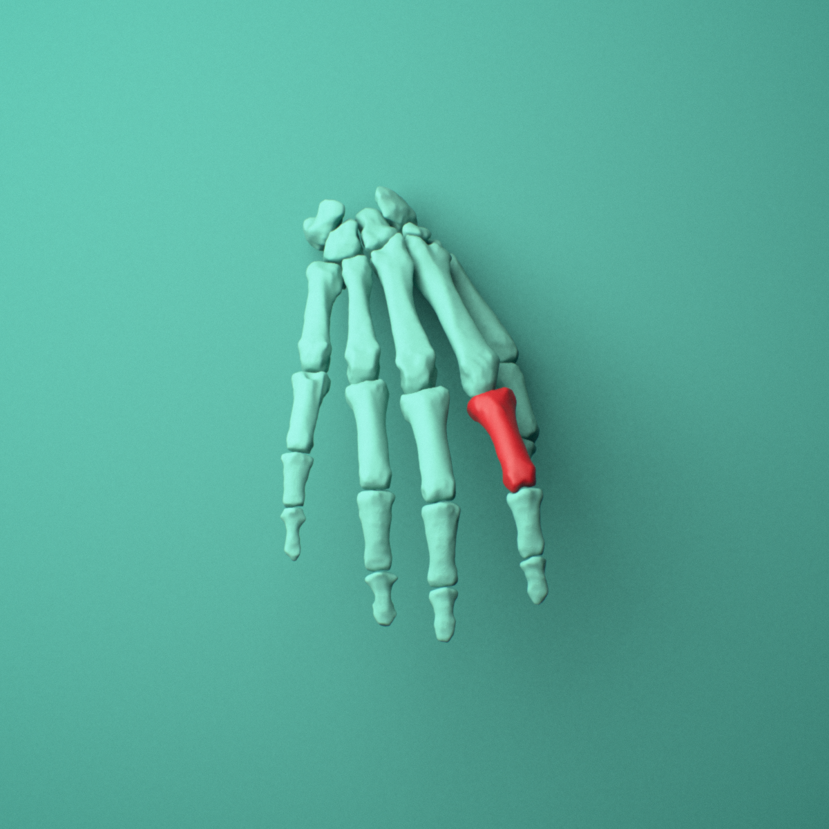 3D model of the Right index finger proximal phalanx shown in position within a full hand and wrist model, anterior view.