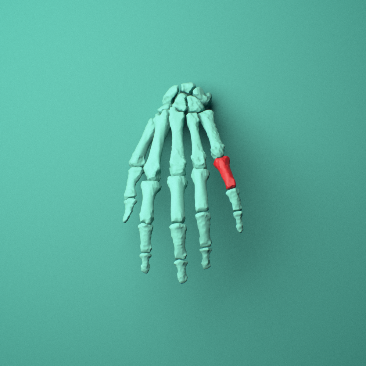 3D model of the Left little finger proximal phalanx shown in position within a full hand and wrist model, anterior view.