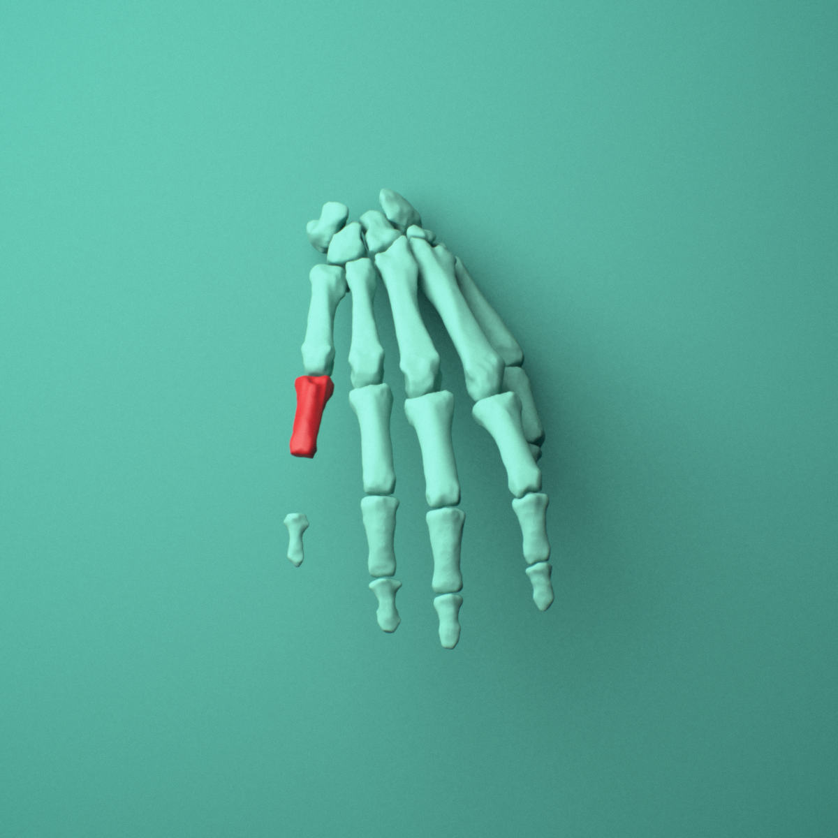 3D model of the Right little finger proximal phalanx shown in position within a full hand and wrist model, anterior view.