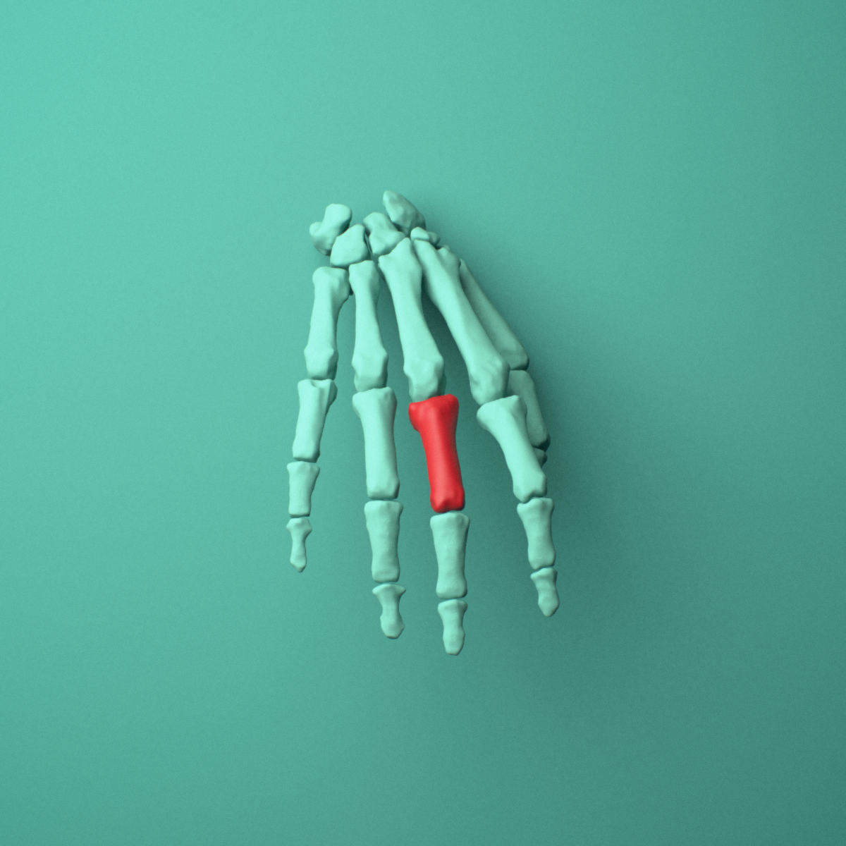 3D model of the Right middle finger proximal phalanx shown in position within a full hand and wrist model, anterior view.