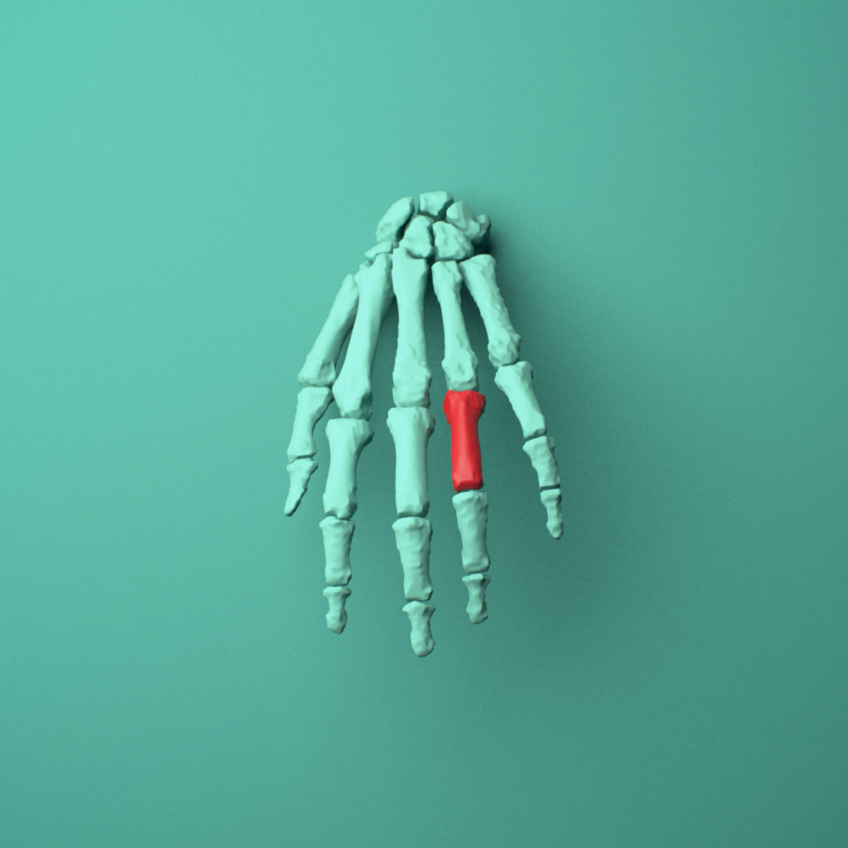 3D model of the Left ring finger proximal phalanx shown in position within a full hand and wrist model, anterior view.
