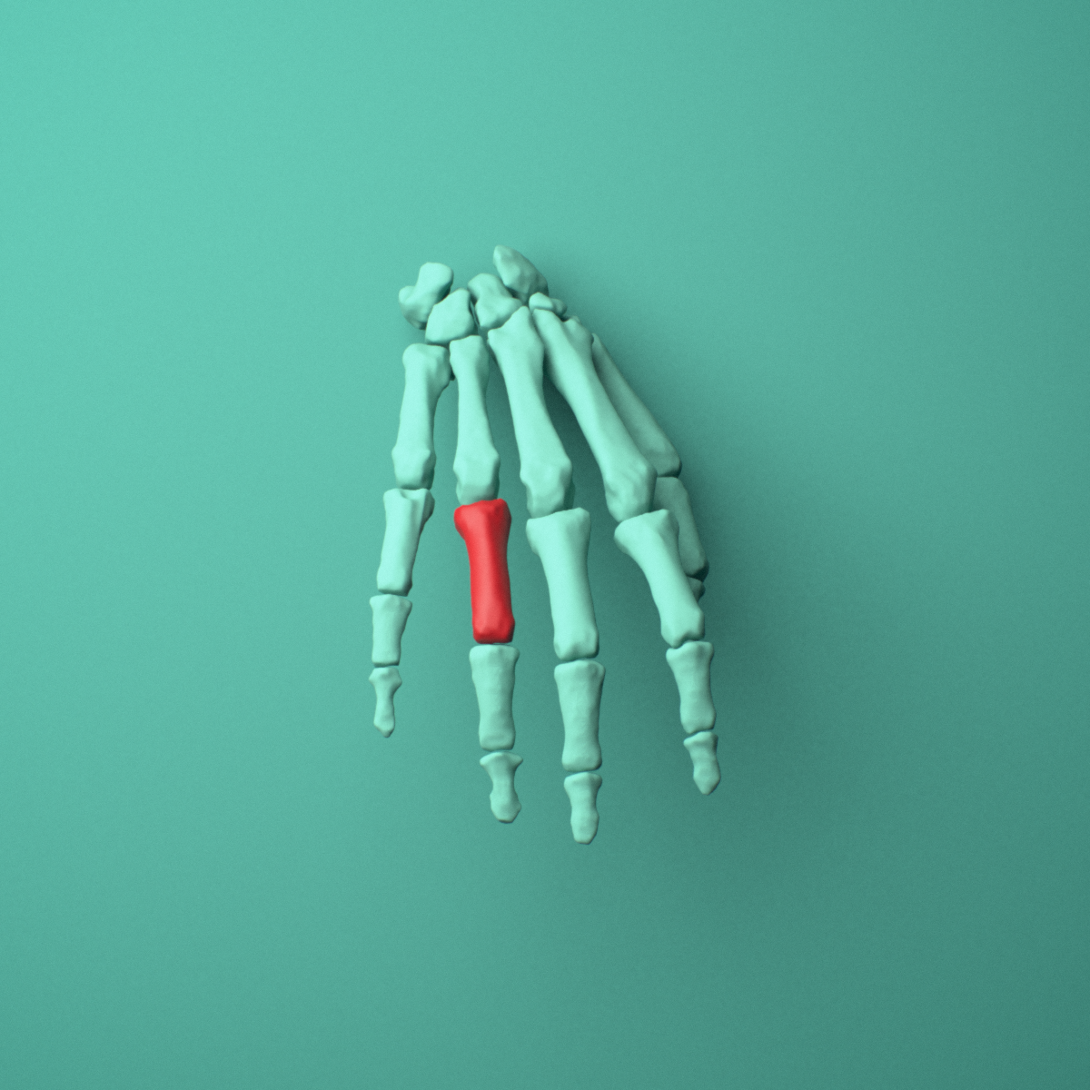 3D model of the Right ring finger proximal phalanx shown in position within a full hand and wrist model, anterior view.