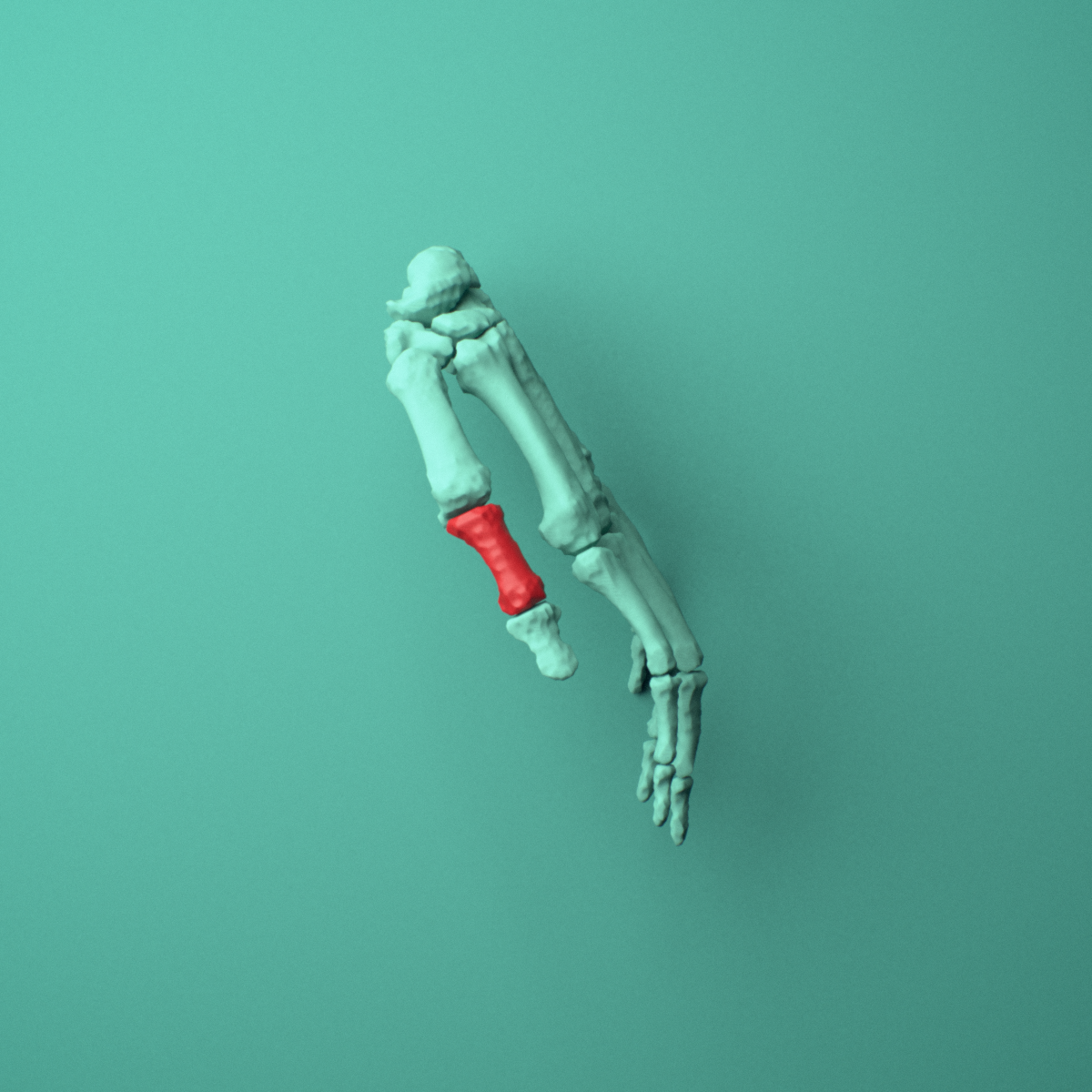3D model of the Left thumb proximal phalanx shown in position within a full hand and wrist model, right lateral view.