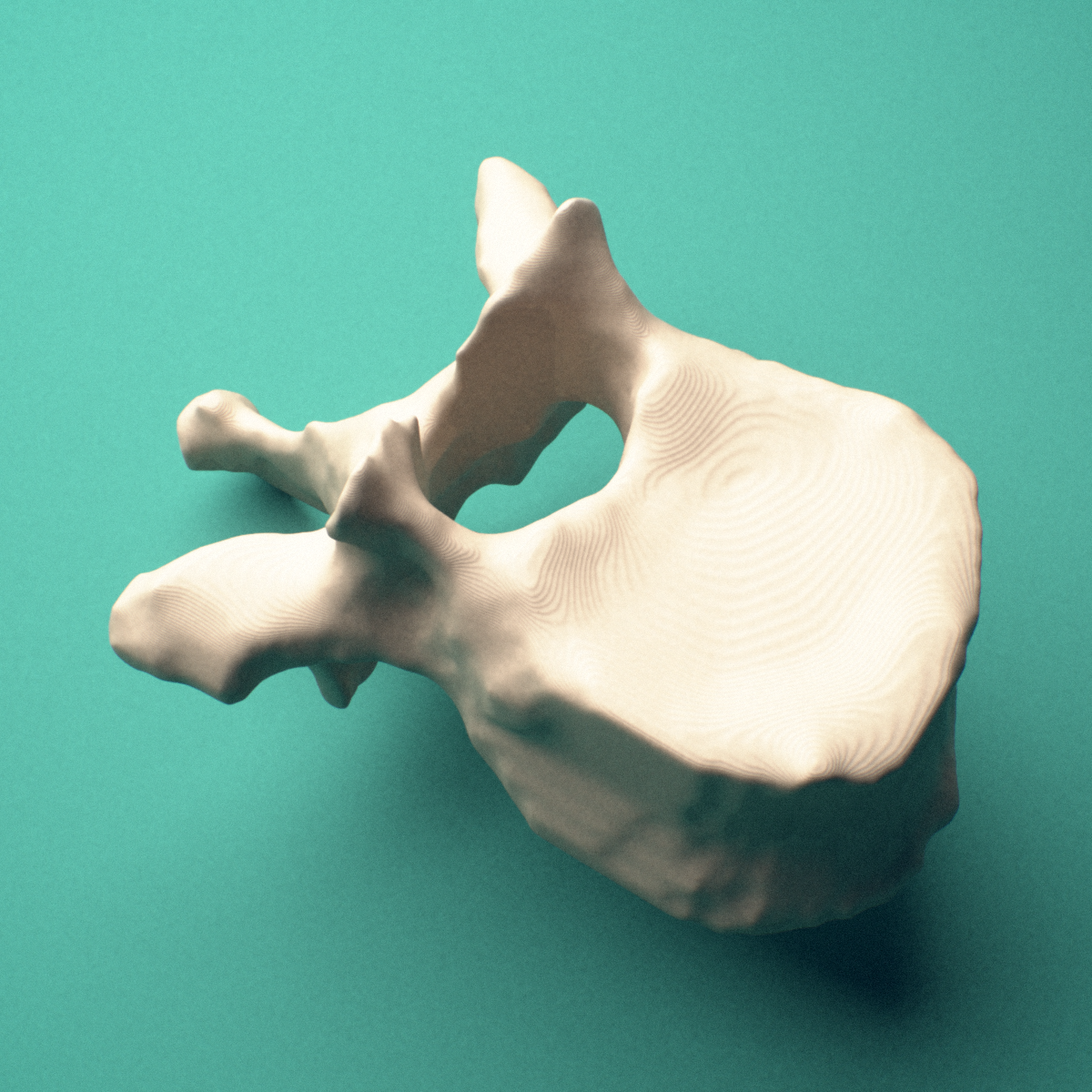 3D-printed T10 thoracic vertebra, posterior oblique view showing the laminae and spinous process.
