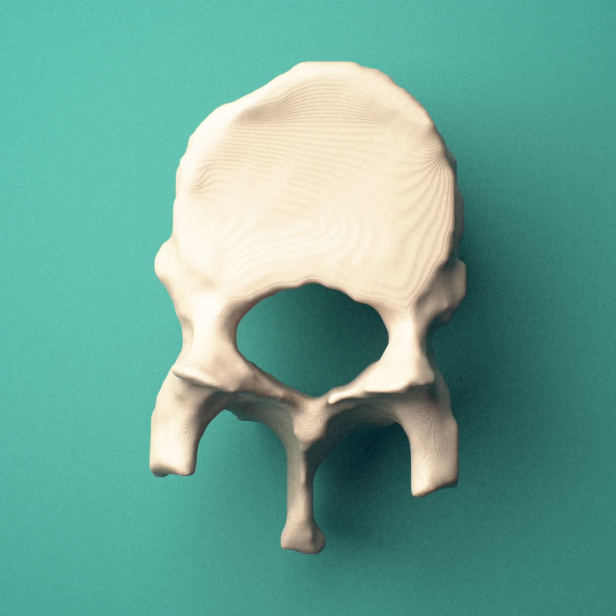 3D-printed T11 thoracic vertebra, superior view showing the vertebral body and vertebral foramen.