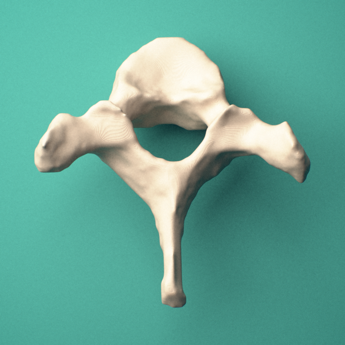 3D-printed T1 thoracic vertebra, superior view showing the vertebral body and vertebral foramen.