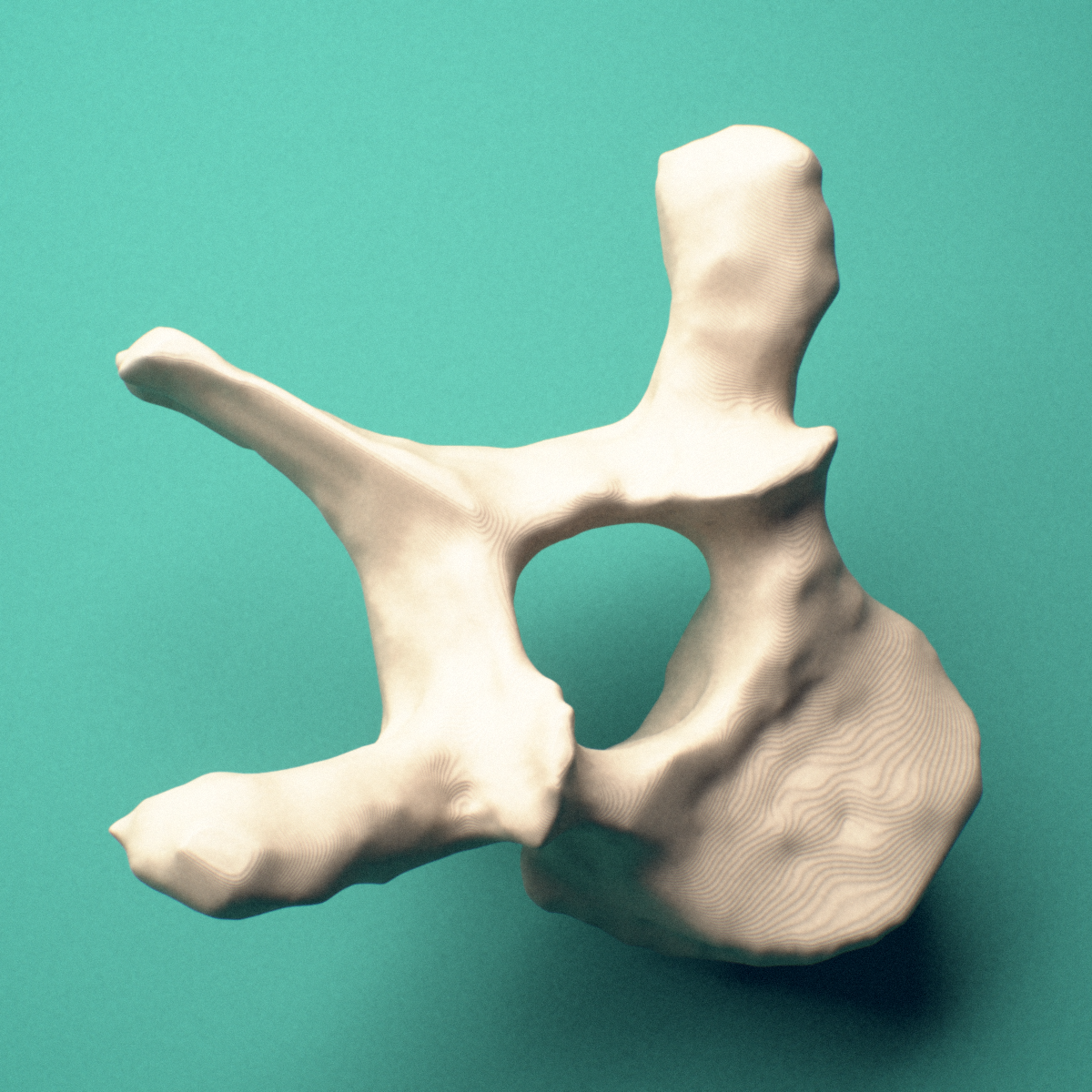 3D-printed T2 thoracic vertebra, posterior oblique view showing the laminae and spinous process.