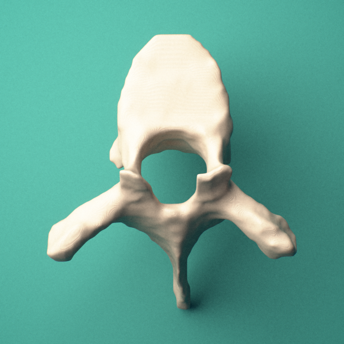 3D-printed T5 thoracic vertebra, superior view showing the vertebral body and vertebral foramen.